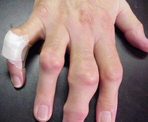 संयुक्त विकृति के साथ उंगलियों में दर्द होता है