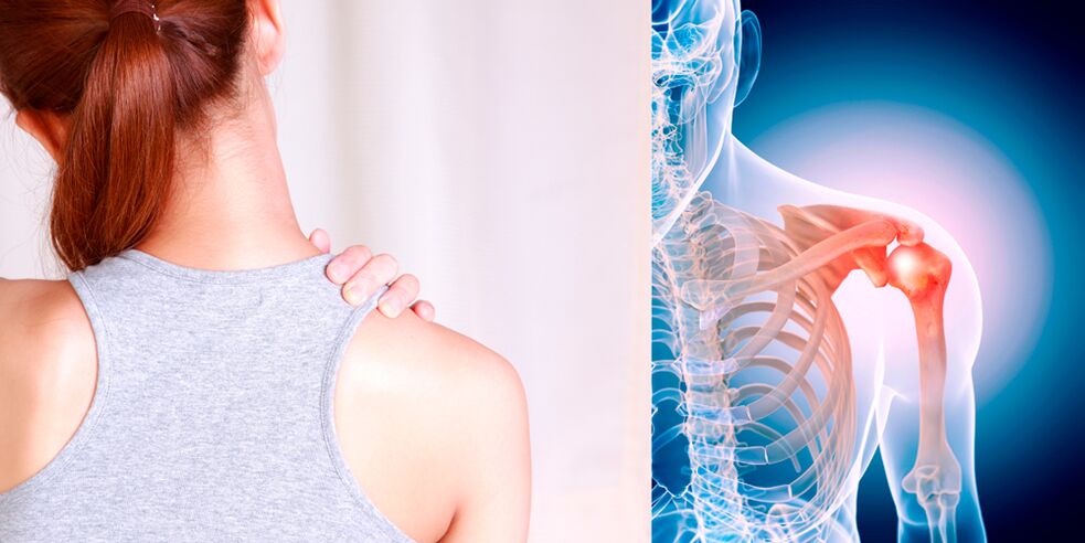 कंधे के पुराने ऑस्टियोआर्थराइटिस के विकास से धीरे-धीरे लगातार दर्द होता है