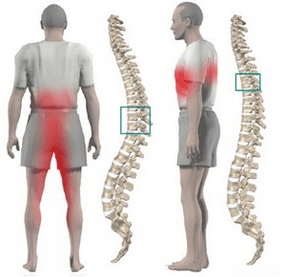 थोरैसिक ओस्टियोचोन्ड्रोसिस में पीठ दर्द