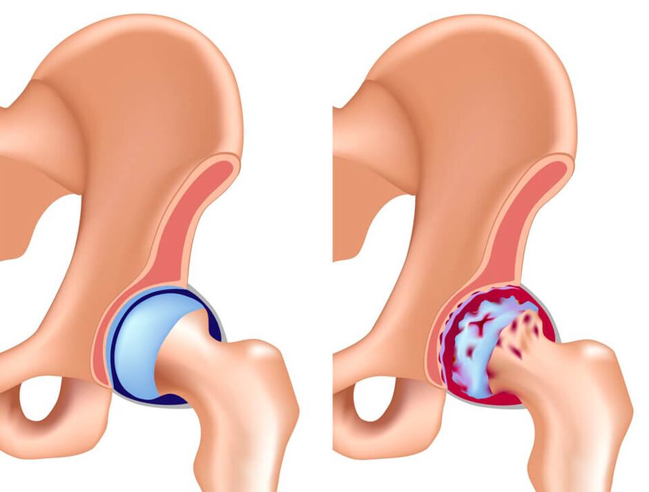 कूल्हे के जोड़ में दर्द का सबसे आम कारण कॉक्सार्थ्रोसिस है।