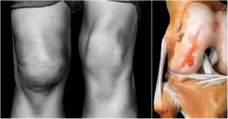 घुटने के जोड़ और गले में संयुक्त के आर्थ्रोसिस